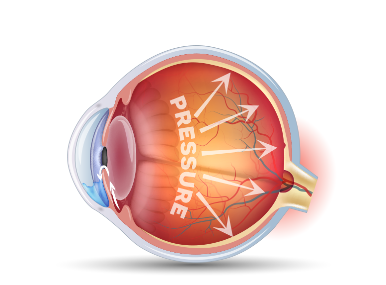 Glaucoma eye Durysta