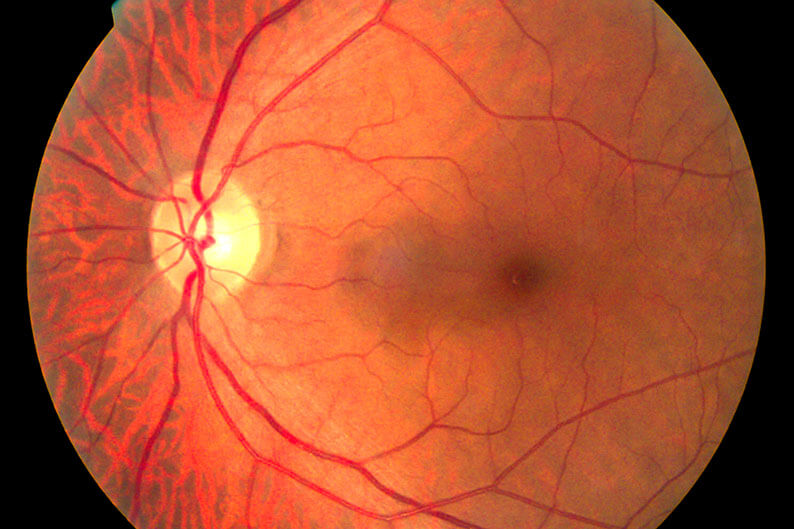 Scan of an Eye With a Detached Retina